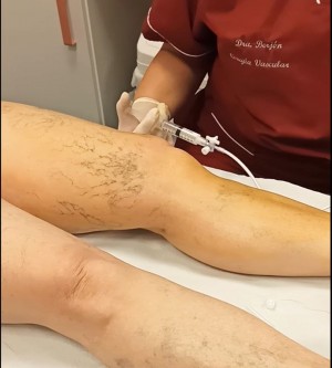 El invierno alivia los s�ntomas de las varices, pero no la enfermedad: la importancia de la prevenci�n vascular